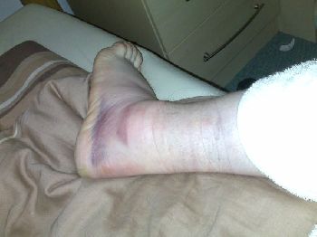 2 days after injury (pic 2)